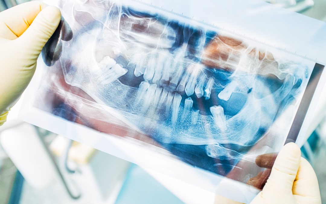 Shine a Light: Exploring the World of Dental X-Rays